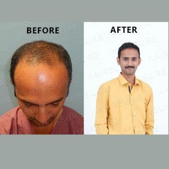 Best Hair Transplant in Hyderabad - Hair Transplant Cost in Hyderabad