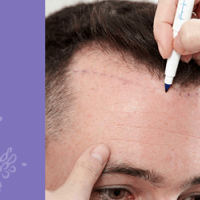 Hair Transplantation in Palakkad, Kerala | India Hair Transplantation in Palakkad, Kerala | India