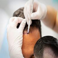 Hair Transplantation in Bodh Gaya, Bihar | India
